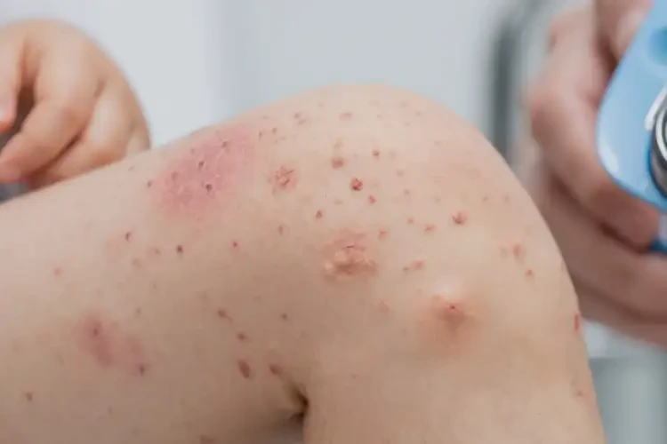 小兒小腿上經(jīng)常起濕疹不管它會(huì)自己痊愈嗎(圖4)