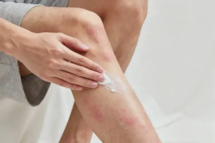 青年人小腿長濕疹能不能徹底自愈(圖2)