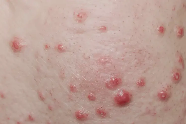 男生脖子偶爾起濕疹不管它會自己好嗎(圖4)