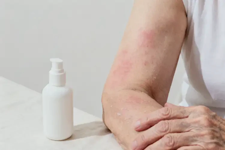 老年人手臂上經(jīng)常長(zhǎng)濕疹可以徹底自愈嗎(圖4)