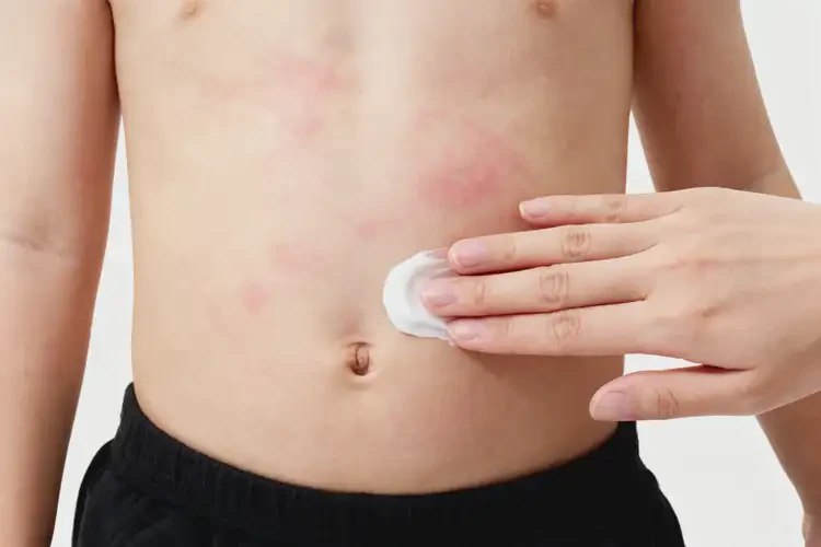 孩子肚子上有濕疹不管它會自己好嗎(圖2)