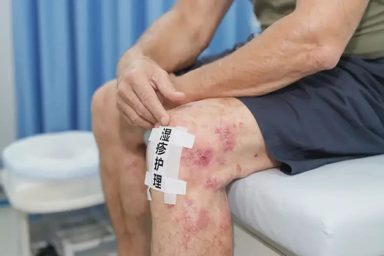 男生大腿經(jīng)常長(zhǎng)濕疹可以徹底自愈嗎(圖4)