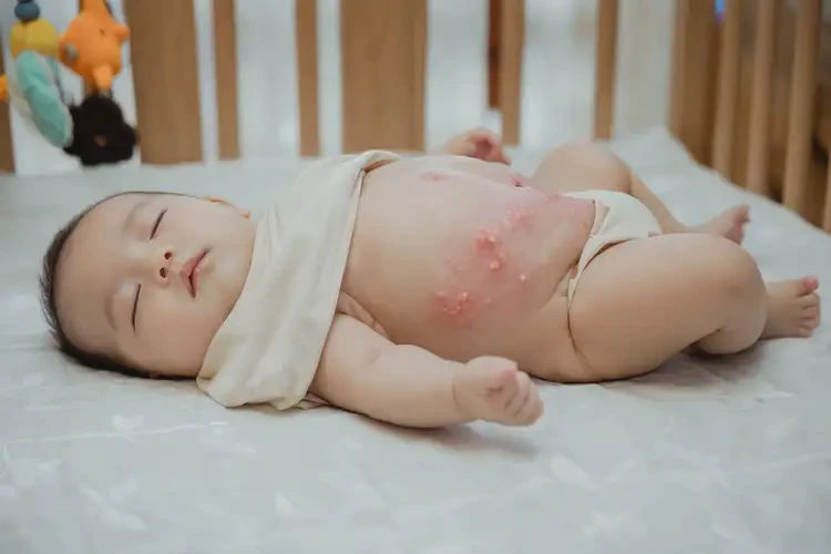 寶寶肚子偶爾起濕疹不管它會自己好嗎(圖4)