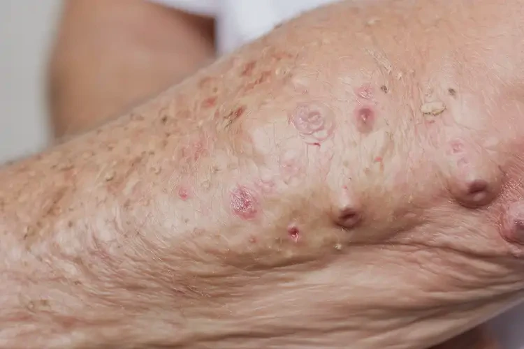 老年人屁股出現(xiàn)濕疹不管它會自己好嗎(圖4)