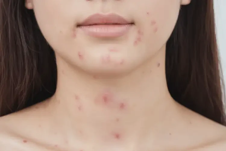 女性脖子上偶尔长湿疹可以彻底自愈吗(图4)