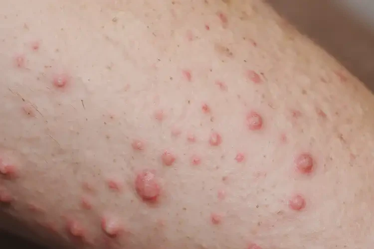 男性四肢出现湿疹不管它会自己痊愈吗(图3)