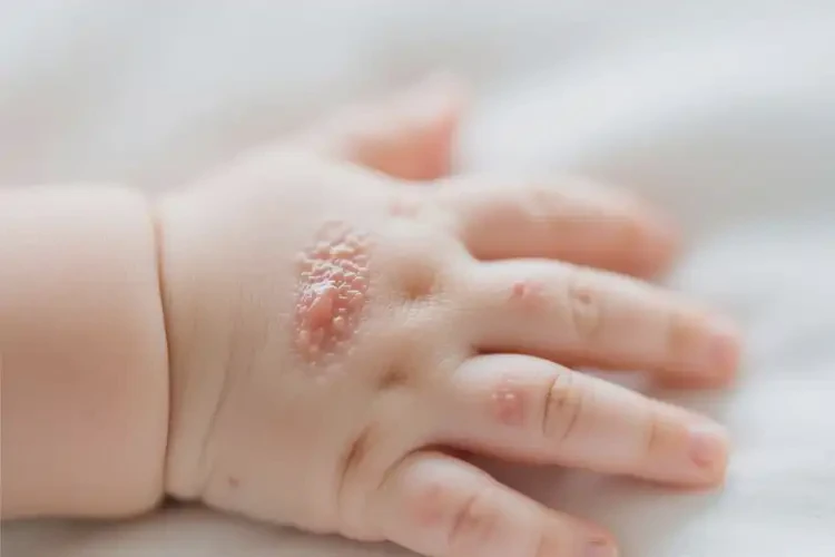 新生兒手上出現(xiàn)濕疹可以徹底自愈嗎(圖2)