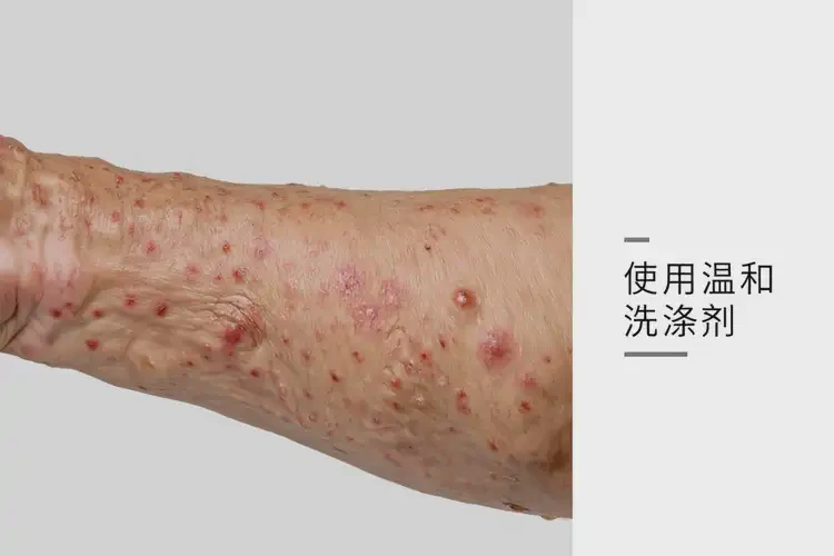 老人屁股經(jīng)常起濕疹不管它會(huì)自己自愈嗎(圖3)