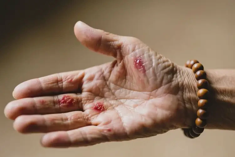老人手上有濕疹不管它會(huì)自己痊愈嗎(圖1)