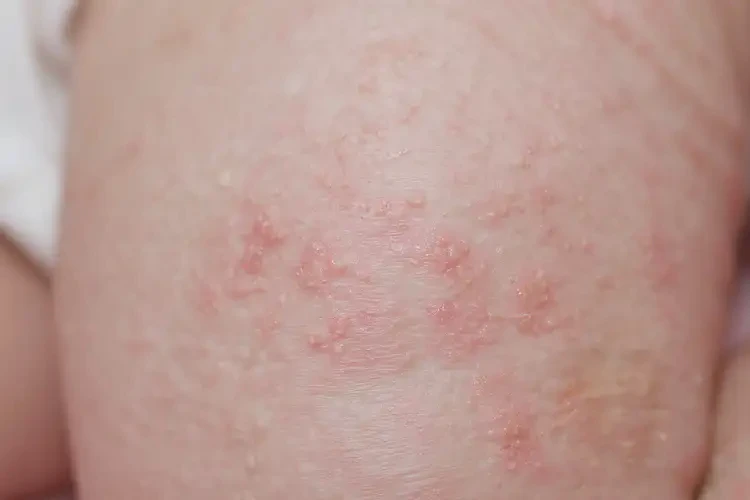 新生兒大腿經(jīng)常長濕疹不管它會自己自愈嗎(圖4)