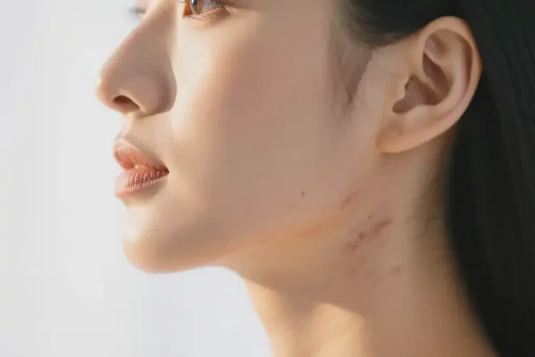 女性臉上起濕疹能靠自己自愈嗎(圖1)