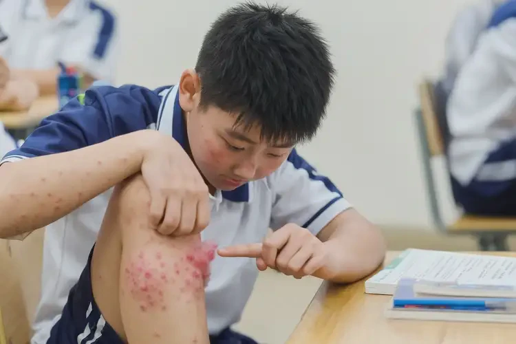 中學(xué)生小腿上偶爾起濕疹能夠徹底治愈嗎(圖4)