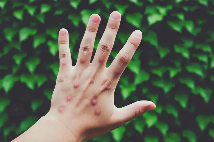 青少年手上經(jīng)常長濕疹不管它會自己好嗎(圖1)
