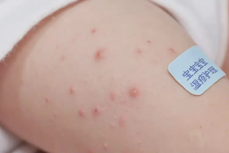 新生兒大腿偶爾長濕疹能徹底自愈嗎(圖4)