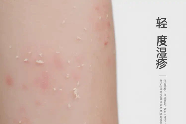 小孩屁股上出現(xiàn)濕疹不管它會(huì)自己好嗎(圖4)