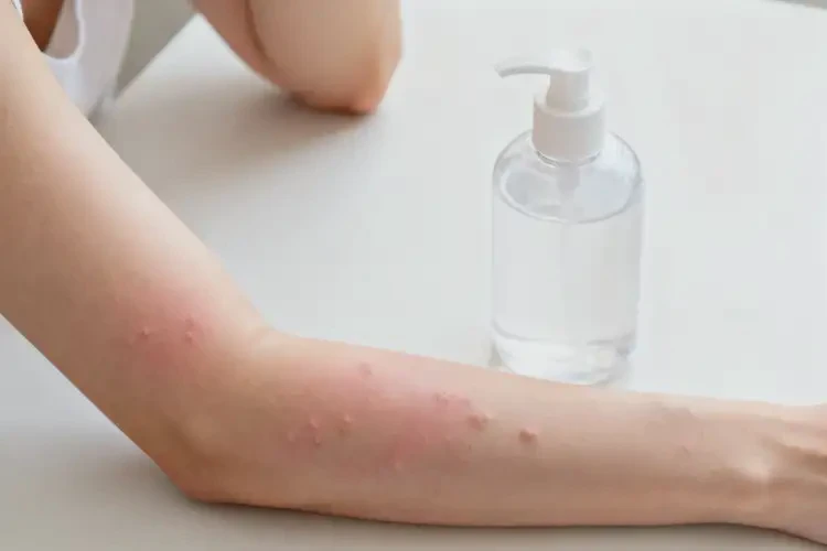 女人身上偶爾起濕疹可以徹底自愈嗎(圖1)