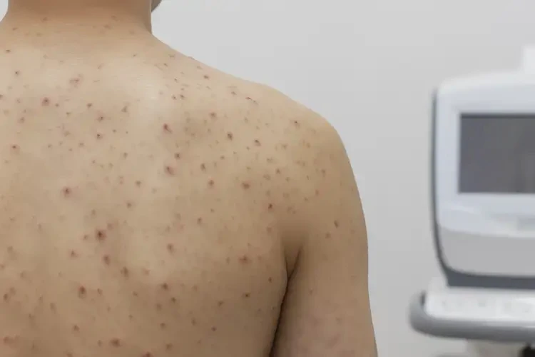 男生屁股經(jīng)常起濕疹能徹底自愈嗎(圖4)