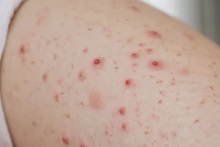 產(chǎn)婦手臂上出現(xiàn)濕疹不管它會(huì)自己好嗎(圖4)