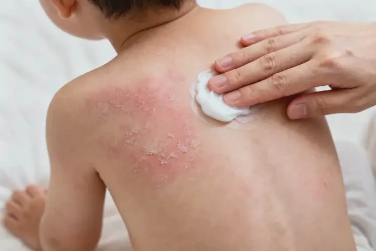 孩子全身偶爾長(zhǎng)濕疹不管它會(huì)自己痊愈嗎(圖2)