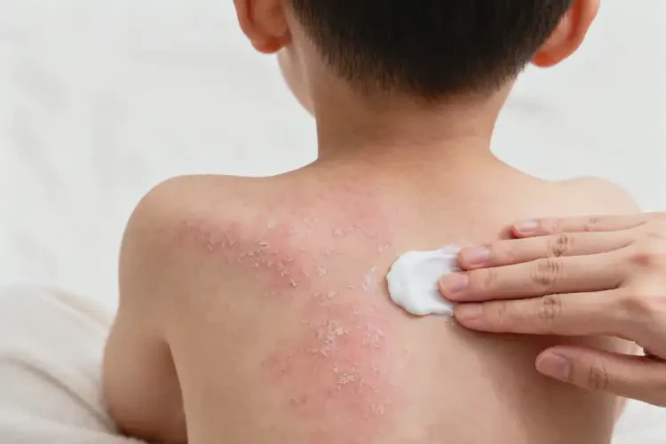 孩子全身偶爾長(zhǎng)濕疹不管它會(huì)自己痊愈嗎(圖3)