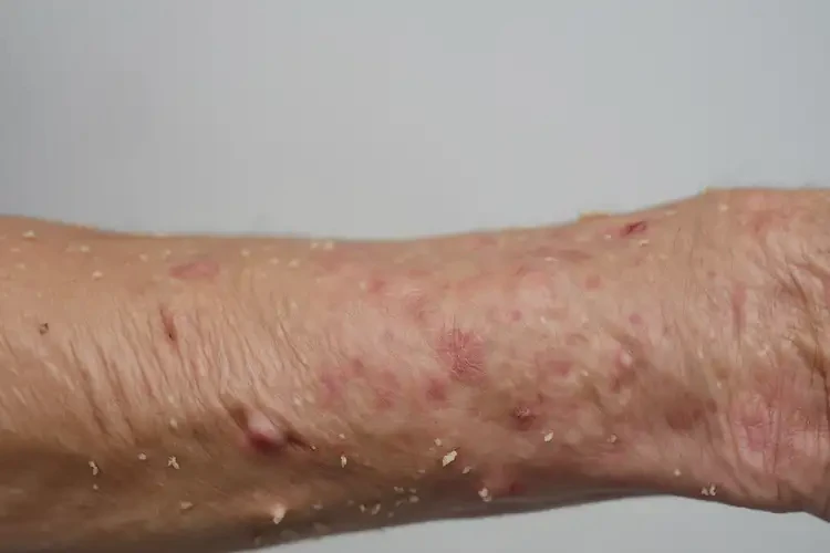 老人手臂長濕疹可不可以徹底自愈(圖4)