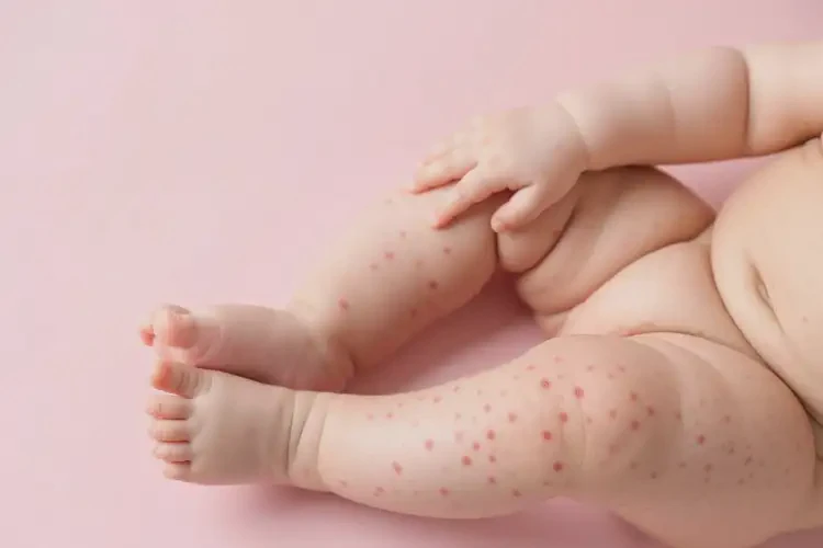 寶寶四肢出濕疹能靠自己自愈嗎(圖3)