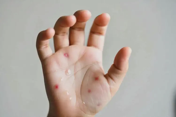 小孩手上偶爾起濕疹不管它會(huì)自己自愈嗎(圖3)
