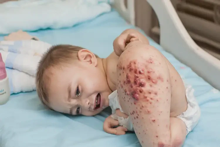 幼兒肚子上出現(xiàn)濕疹能不能徹底自愈(圖2)