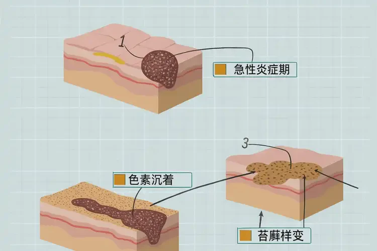 男人屁股偶爾起濕疹不管它會自己痊愈嗎(圖1)