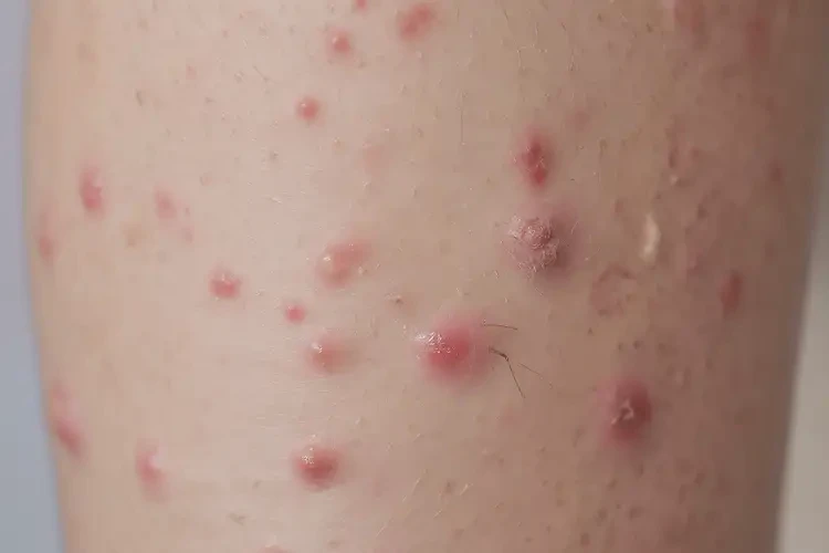 儿童四肢出湿疹可不可以彻底自愈(图4)