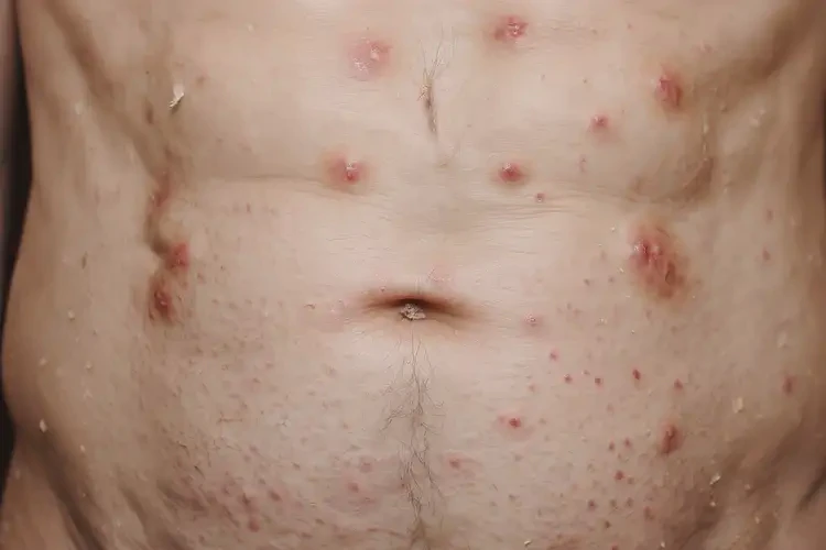 老人肚子上偶爾起濕疹可以徹底自愈嗎(圖4)