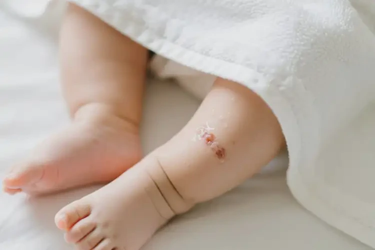 嬰幼兒小腿有濕疹可以徹底自愈嗎(圖1)