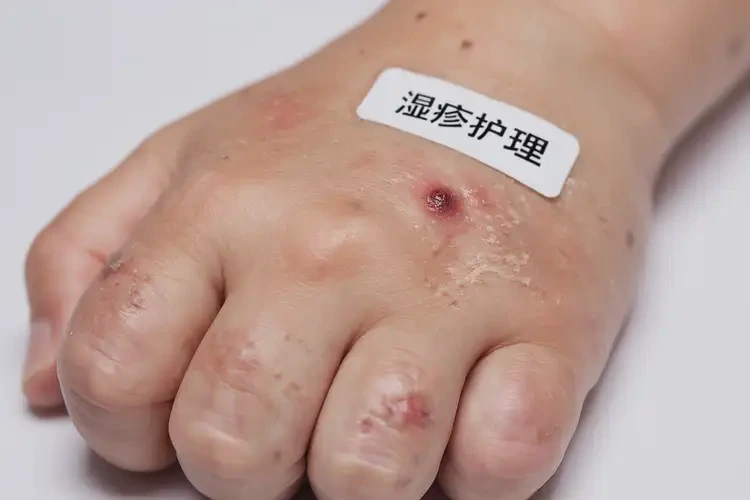 兒童手上偶爾起濕疹能徹底自愈嗎(圖4)