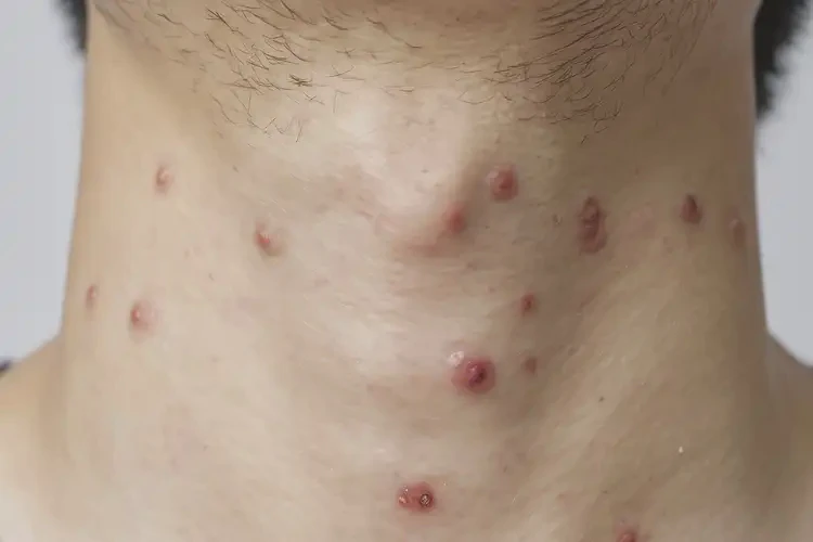 中学生脖子上容易长湿疹可以彻底自愈吗(图4)