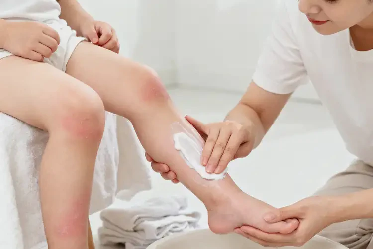 幼兒小腿經(jīng)常長濕疹不管它會自己自愈嗎(圖1)