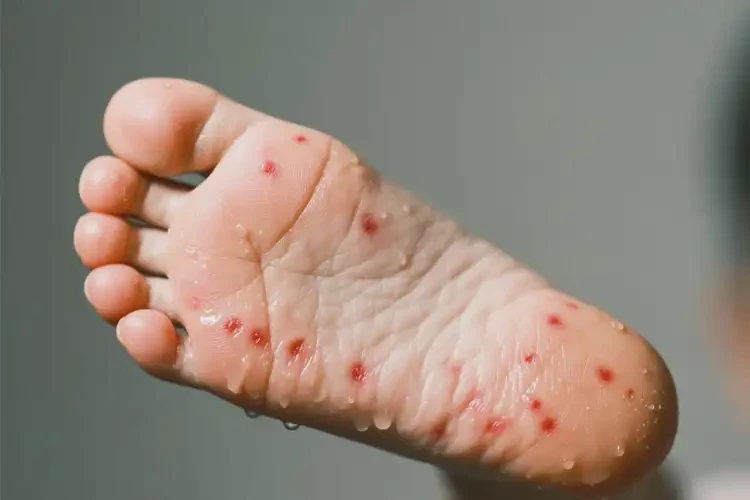 小孩腳上出現(xiàn)濕疹不管它會自己自愈嗎(圖3)