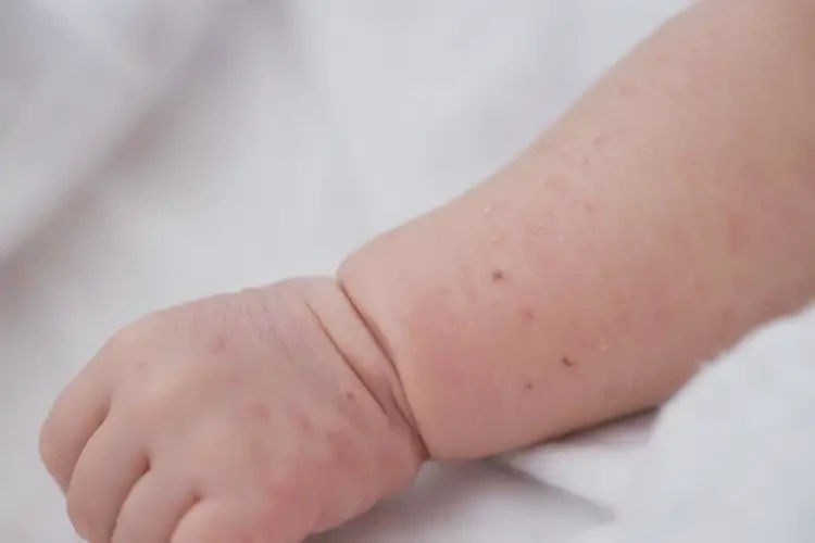 新生兒手臂容易起濕疹能徹底自愈嗎(圖3)