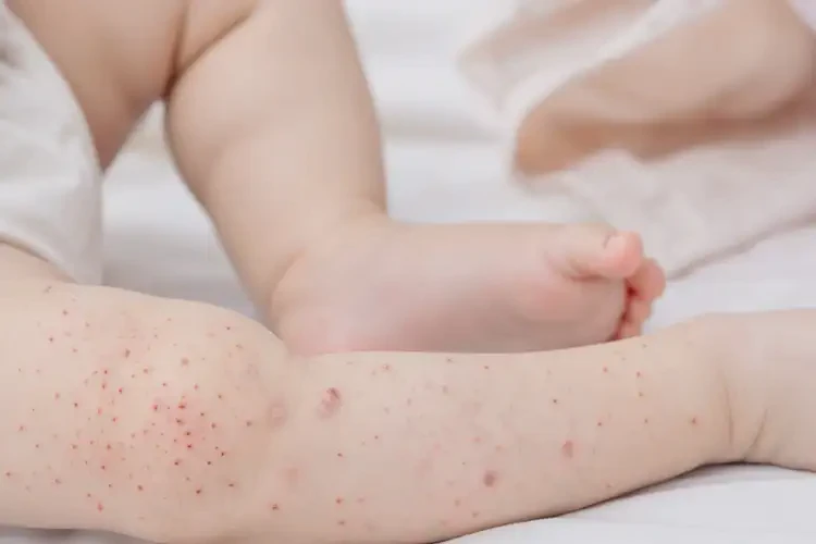 幼兒四肢出現(xiàn)濕疹可不可以徹底自愈(圖4)