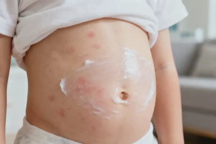 少兒肚子上偶爾長(zhǎng)濕疹不管它會(huì)自己自愈嗎(圖4)