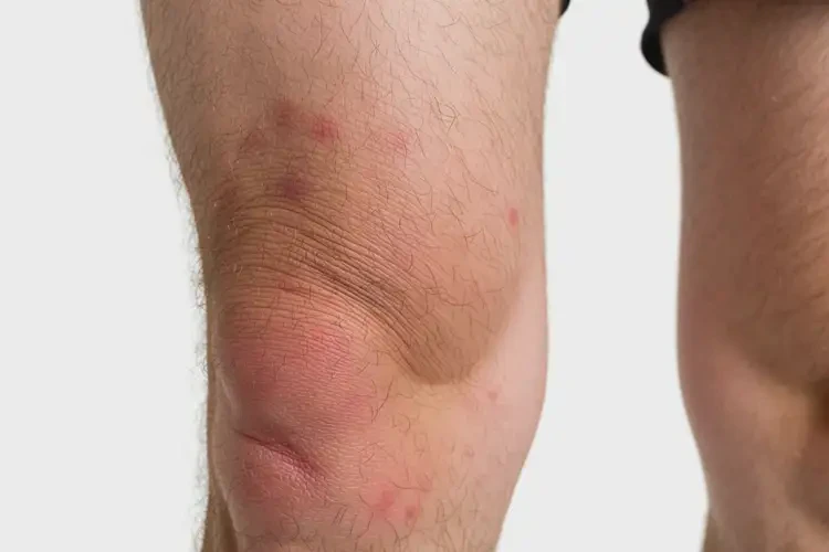 男人大腿長濕疹不管它會自己痊愈嗎(圖4)