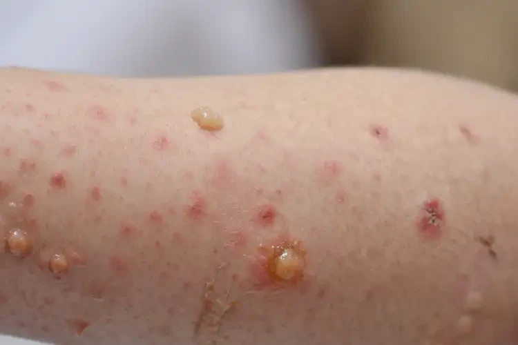 小孩屁股上出現(xiàn)濕疹不管它會(huì)自己好嗎(圖3)