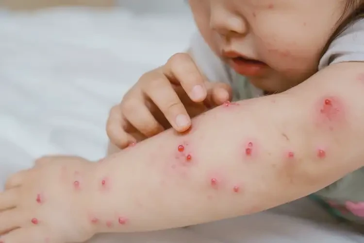 孩子身上容易长湿疹能靠自己自愈吗(图4)