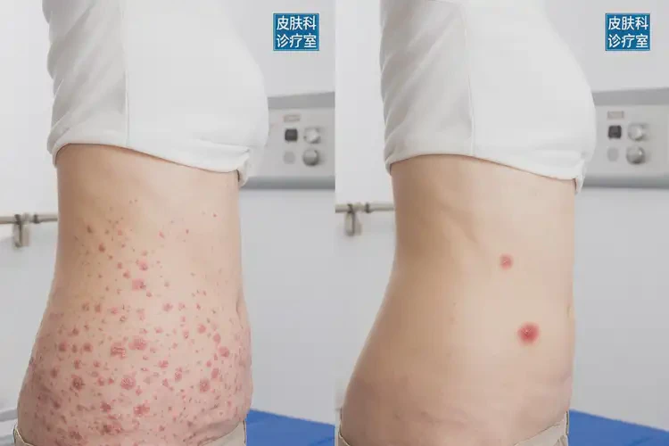 女性肚子上長濕疹不管它會自己好嗎(圖2)