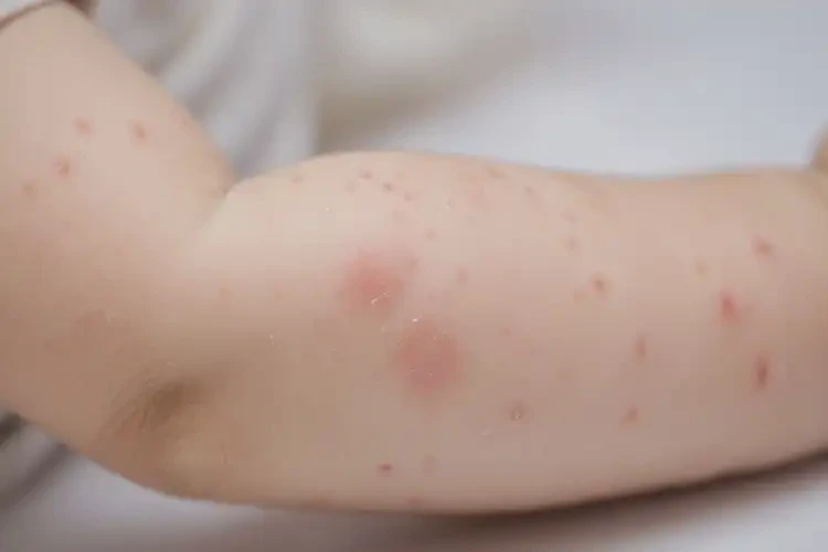 幼儿手臂上出现湿疹可不可以彻底自愈(图4)