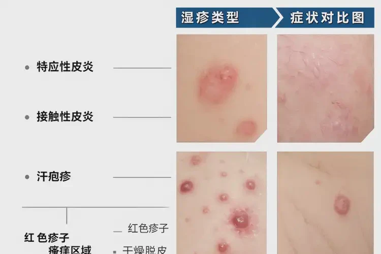 中学生脖子上容易长湿疹可以彻底自愈吗(图1)