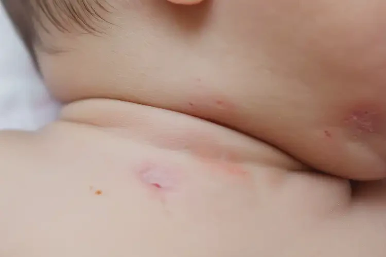 新生兒脖子上出濕疹不管它會(huì)自己痊愈嗎(圖4)
