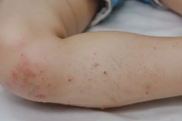 孩子小腿上偶爾長濕疹不管它會自己好嗎(圖4)