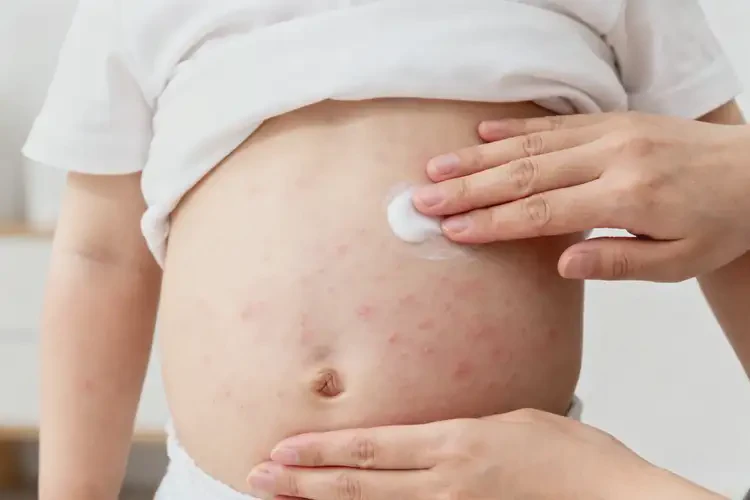 幼兒肚子長濕疹不管它會自己自愈嗎(圖2)