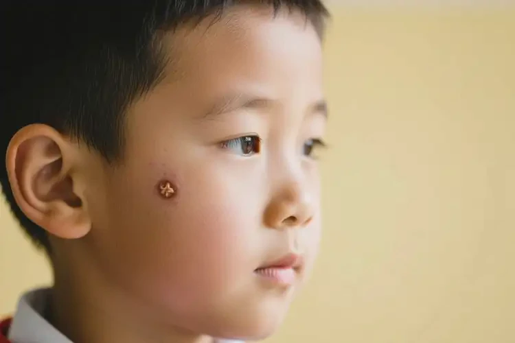 小學(xué)生面部偶爾長(zhǎng)濕疹不管它會(huì)自己好嗎(圖1)