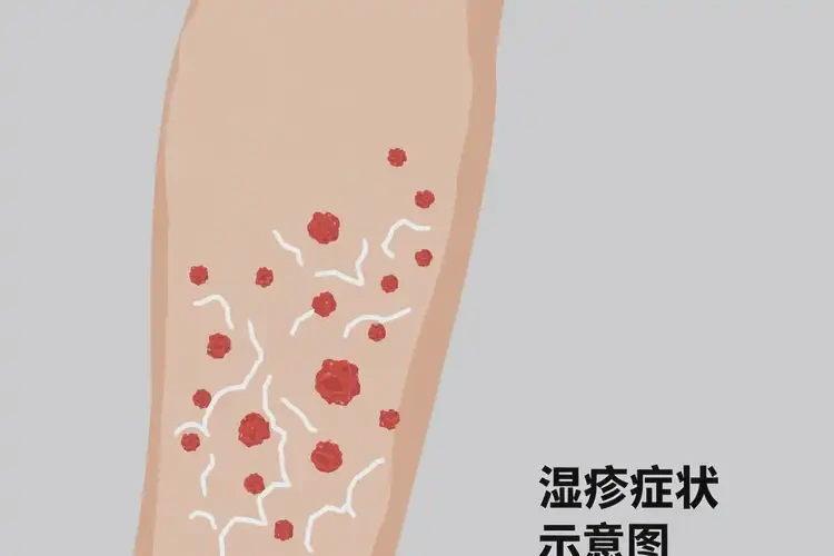 女生肚子出濕疹不管它會自己自愈嗎(圖4)